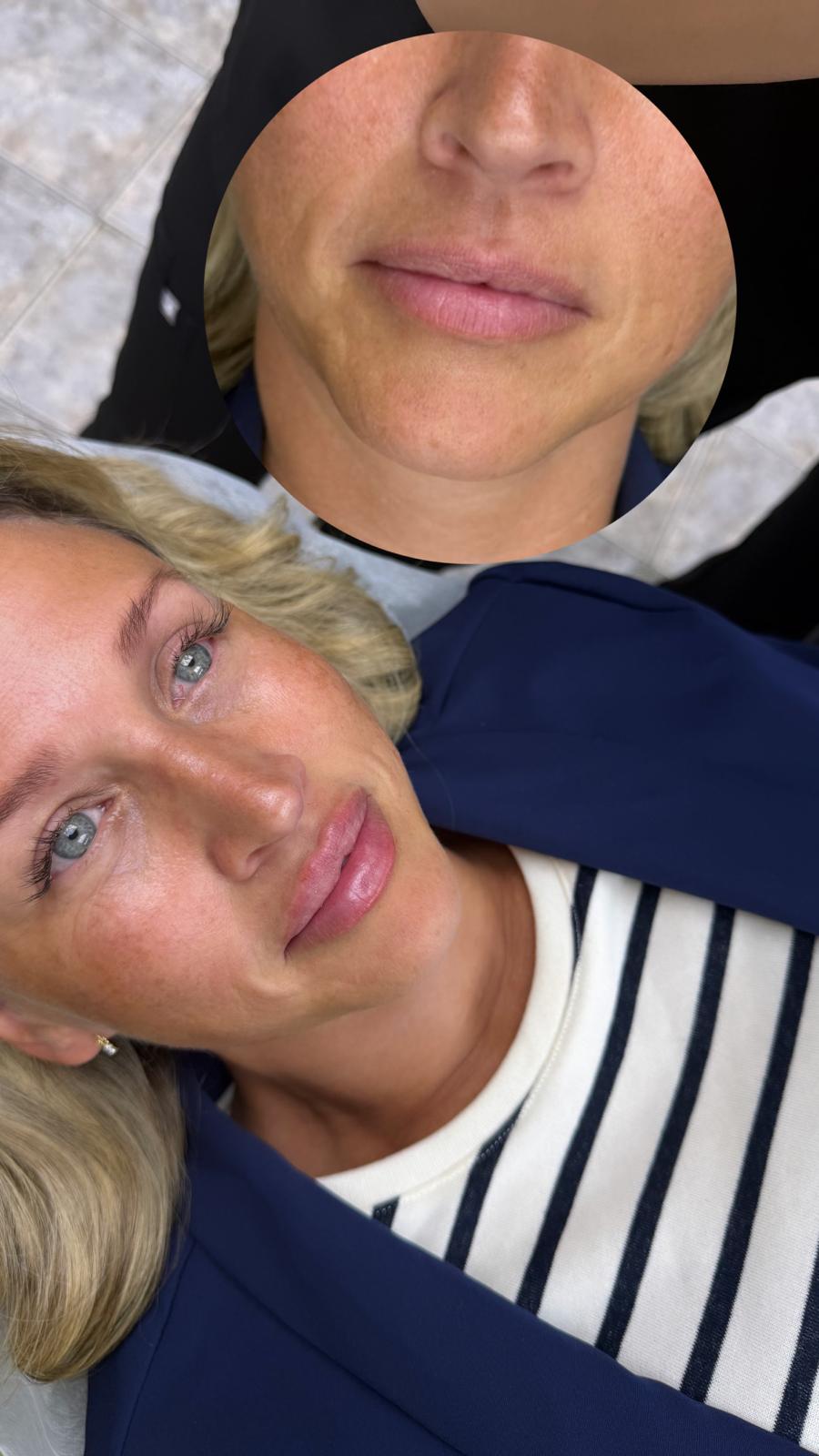 Lip filler result with a circular before-treatment comparison