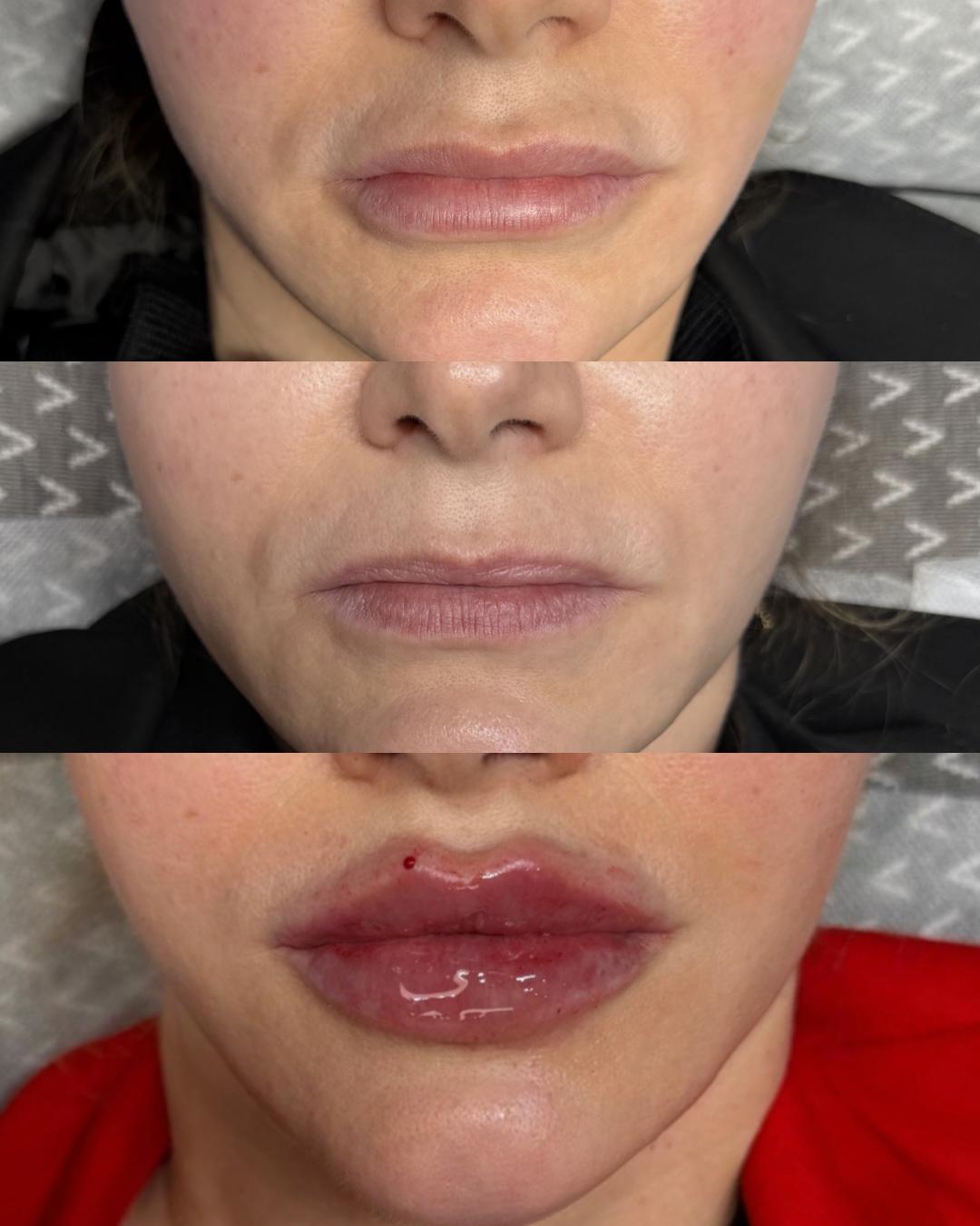 Three stages of lip treatment before and after dissolving and filling